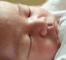 Akne za novorojenčka