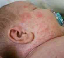 Alergijski izpuščaji pri otroku