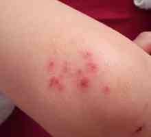 Atopijski dermatitis pri otrocih