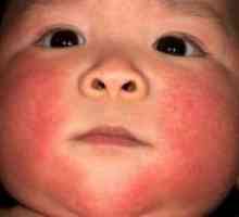 Atopijski dermatitis pri dojenčkih