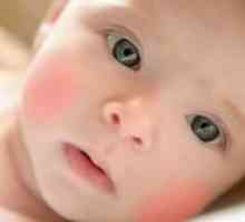 Alergijski ajdovih pri dojenčkih