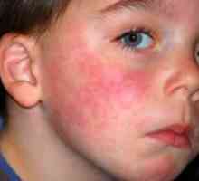 Simptomi alergije pri otrocih