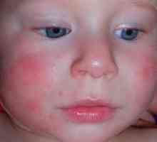 Atopijski dermatitis pri otrocih - Zdravljenje