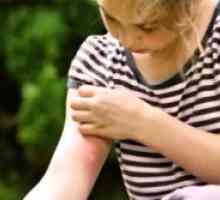 Kako za zdravljenje piki komarjev otroka?