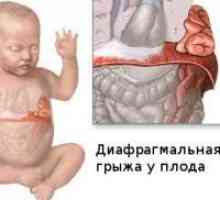 Preponska kila pri novorojenčkih