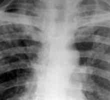 Razširjajo tuberkuloza