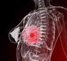 Benigna dojke tumorja - Zdravljenje