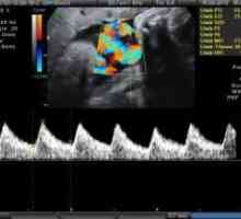 Doplerometrii med nosečnostjo