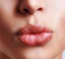 Herpes na ustnicah - hitro zdravljenje