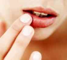 Herpes na ustnicah - vzroki