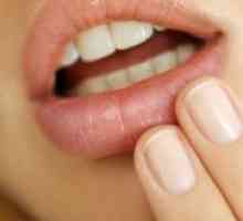 Herpes na ustnici