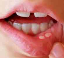 Herpes na ustih otroka