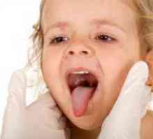 Herpangina pri otrocih - Zdravljenje