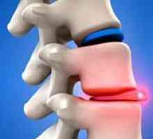 Hrbtenice hernia - Simptomi in zdravljenje