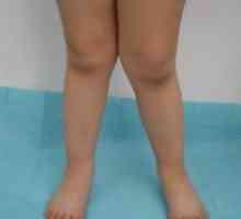 V obliki črke X noge pri otrocih