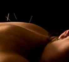 Akupunktura za hujšanje