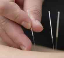 Akupunktura v osteohondroze