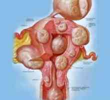 Skupni notranji fibroidi