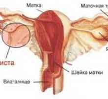 Corpus maternice Endometrioza