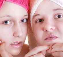Kako se znebiti najstniških akne