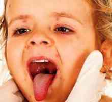 Kako za zdravljenje herpes v grlu otroka?
