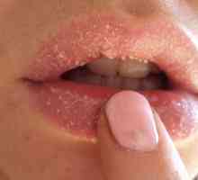 Kako ozdraviti razpokane ustnice?
