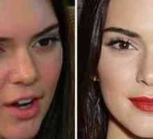 Kendall Jenner pred in po plastike