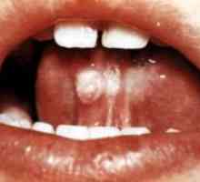 Oslovski kašelj: simptomi pri otrocih