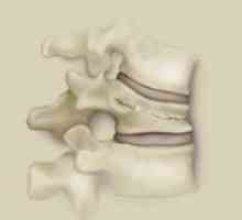 Zlom stiskanje hrbtenice - posledice