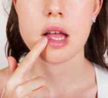 Zdravljenje herpesa na ustnicah v enem dnevu