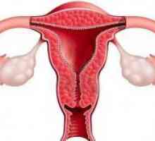 Zdravljenje hiperplazijo endometrija po kiretaža