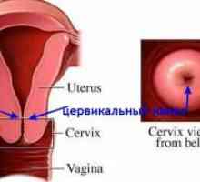 Zdravljenje kronične cervicitisa