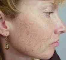 Brazgotina zdravljenje aken na obrazu