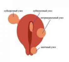 Fibroidi - Vzroki