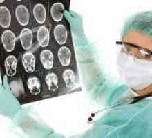 Možganski tumor - simptomi v zgodnjih fazah