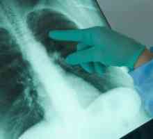 Plevritis pljučnega raka pri
