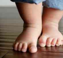 Ploskovalgusnye noge pri otrocih