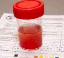 Povečane rdečih krvničk v urinu