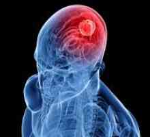 Brain Cancer - Simptomi