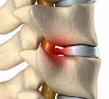 Rak hrbtenice - Simptomi in znaki