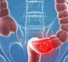 Rak sigmoidno debelega črevesa - prvi simptomi