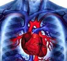 Srce revmatizem
