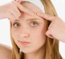 Rešitev za akne na obrazu za najstnike