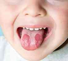 Stomatitis pri otrocih