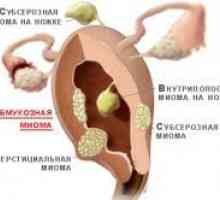 Submukozno fibroidi - obdelava