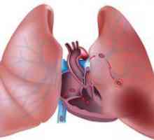 Pljučna embolija - simptomi, zdravljenje