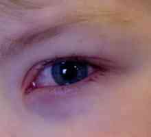 Otrok ima rdeče oči, zakaj in kaj storiti?