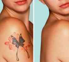 Odstranitev Tattoo laser