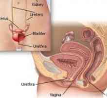 Uretritis pri ženskah - Simptomi