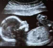 Ultrazvok - 22 tednu nosečnosti